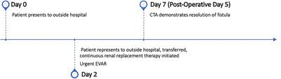 Ruptured Iliac Arteriovenous Fistula Presenting With Thigh Pain and Swelling: Case Report